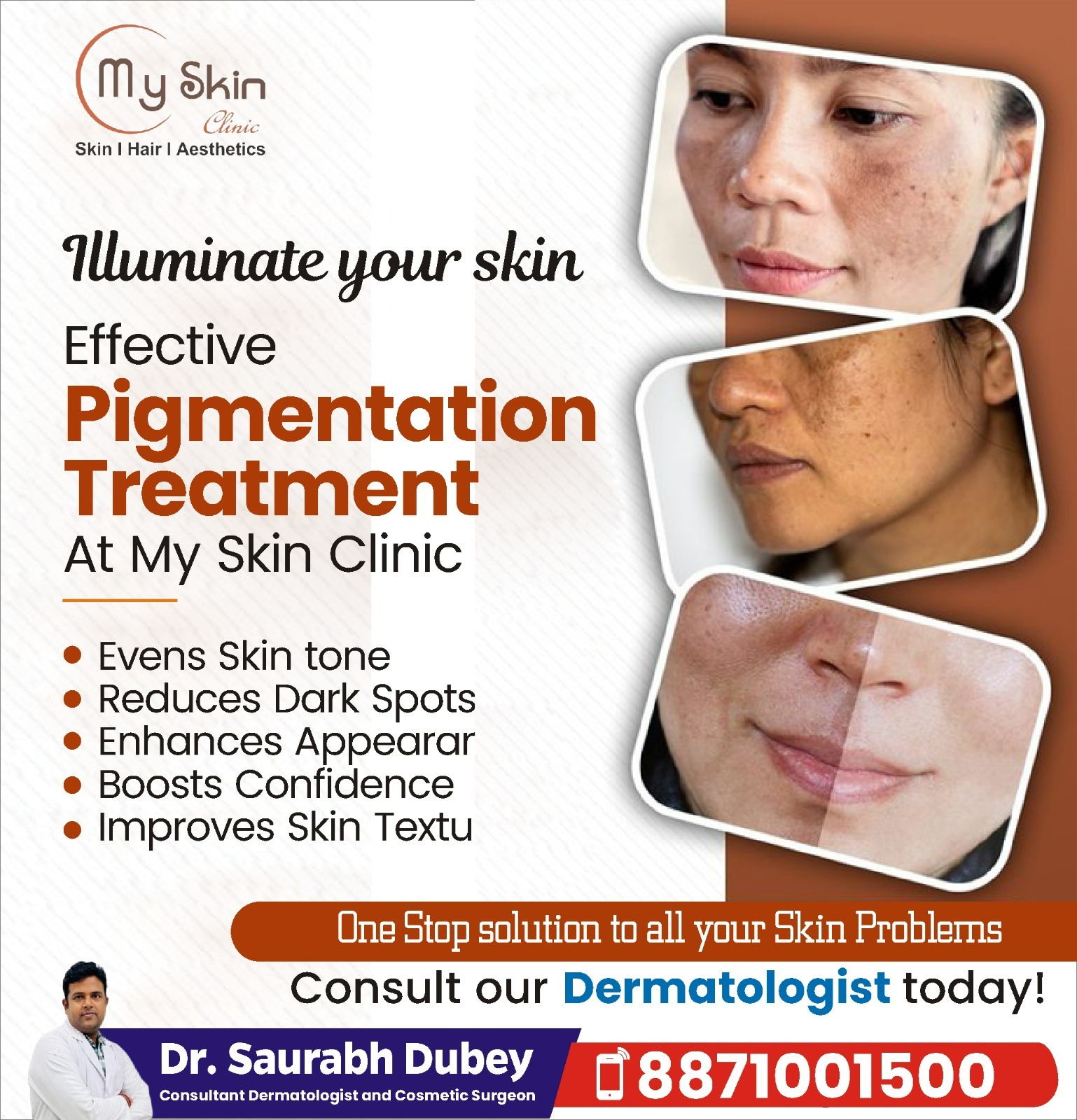 Pigmentation Treatment in Indore